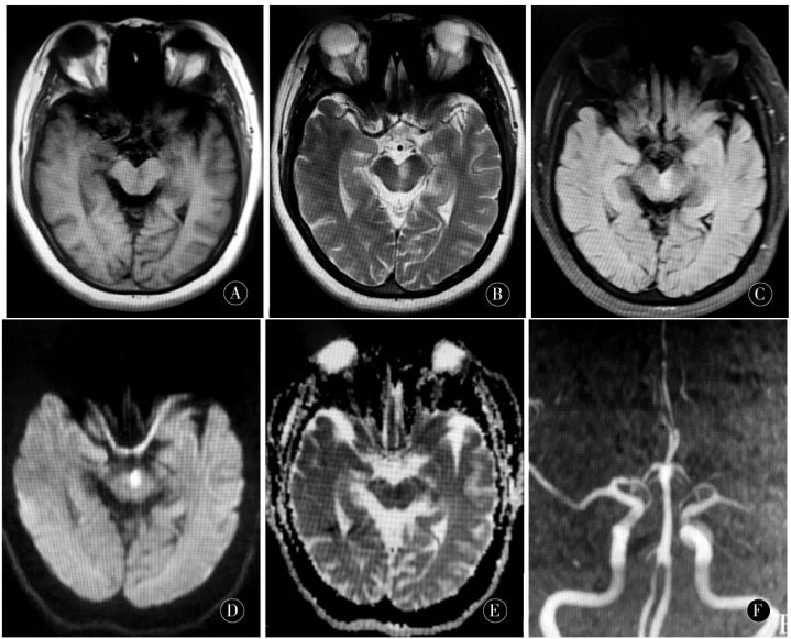 Claude Syndrome: Clinical Report and Analysis