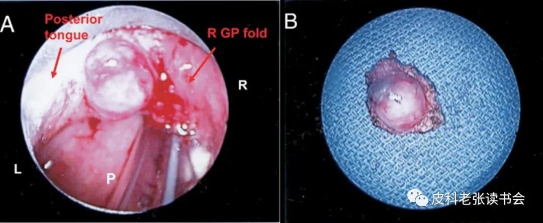 Merkel Cell Carcinoma Is Not Derived From Merkel Cells!