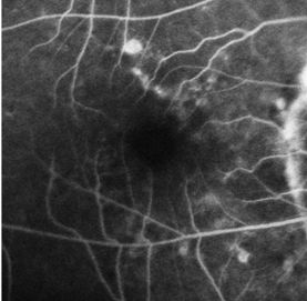 Understanding Multifocal Choroiditis Through Angio-OCT