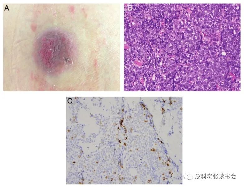 Merkel Cell Carcinoma Is Not Derived From Merkel Cells!