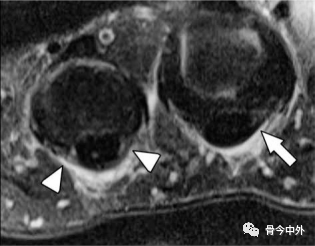 Latest Review: MRI Diagnostic Techniques for Little Finger and Thumb